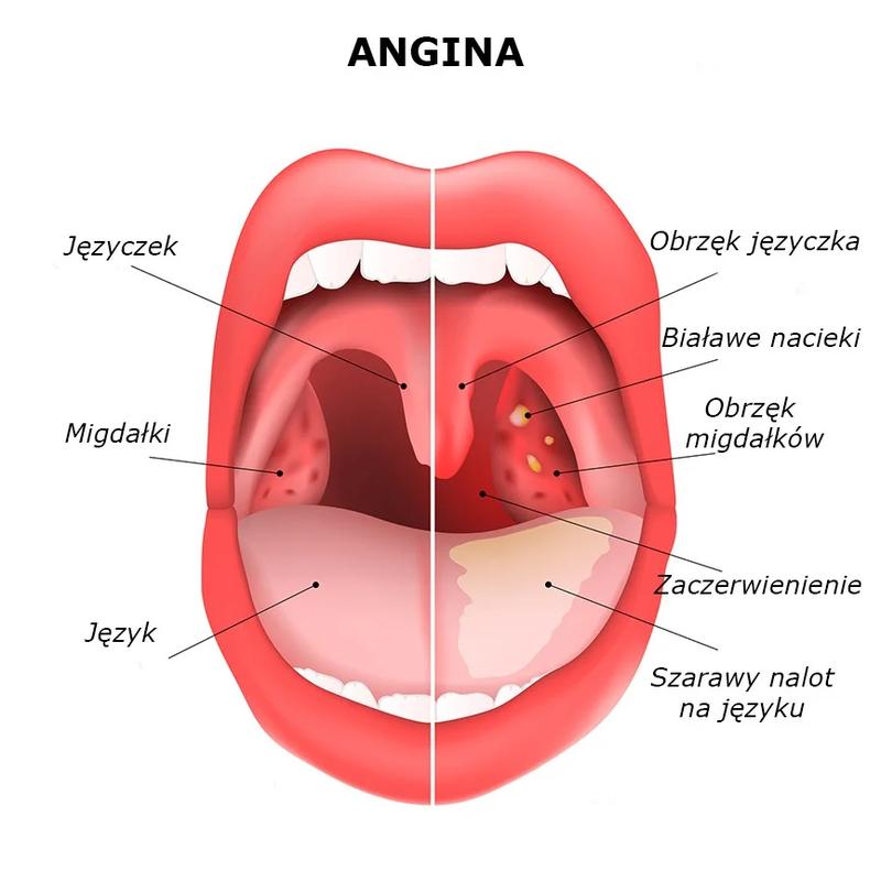 Jak rozpoznać objawy anginy i zrozumieć jej przebieg?