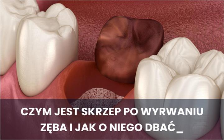 Palenie po ekstrakcji zęba